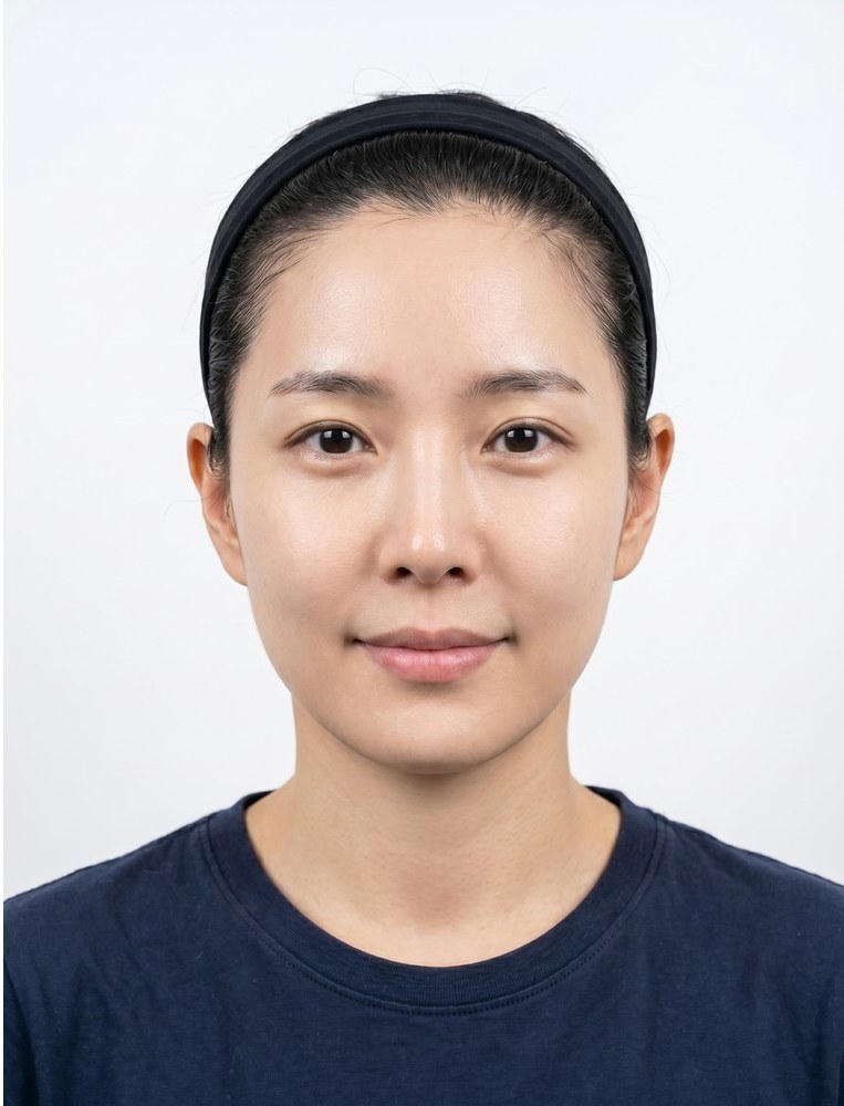 보톡스 after