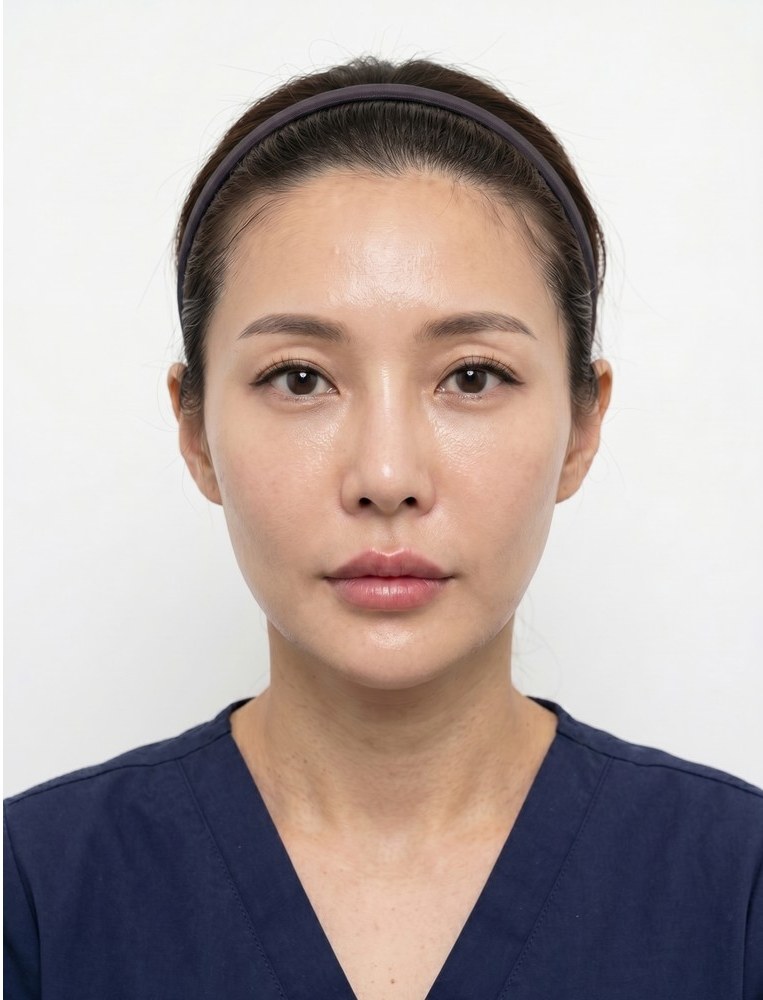 필러 after