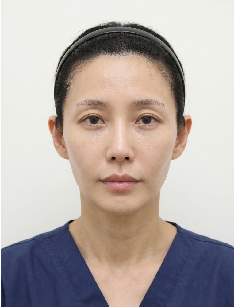 필러 after