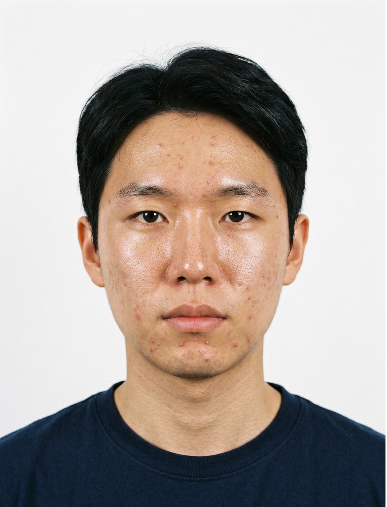 스킨부스터 before