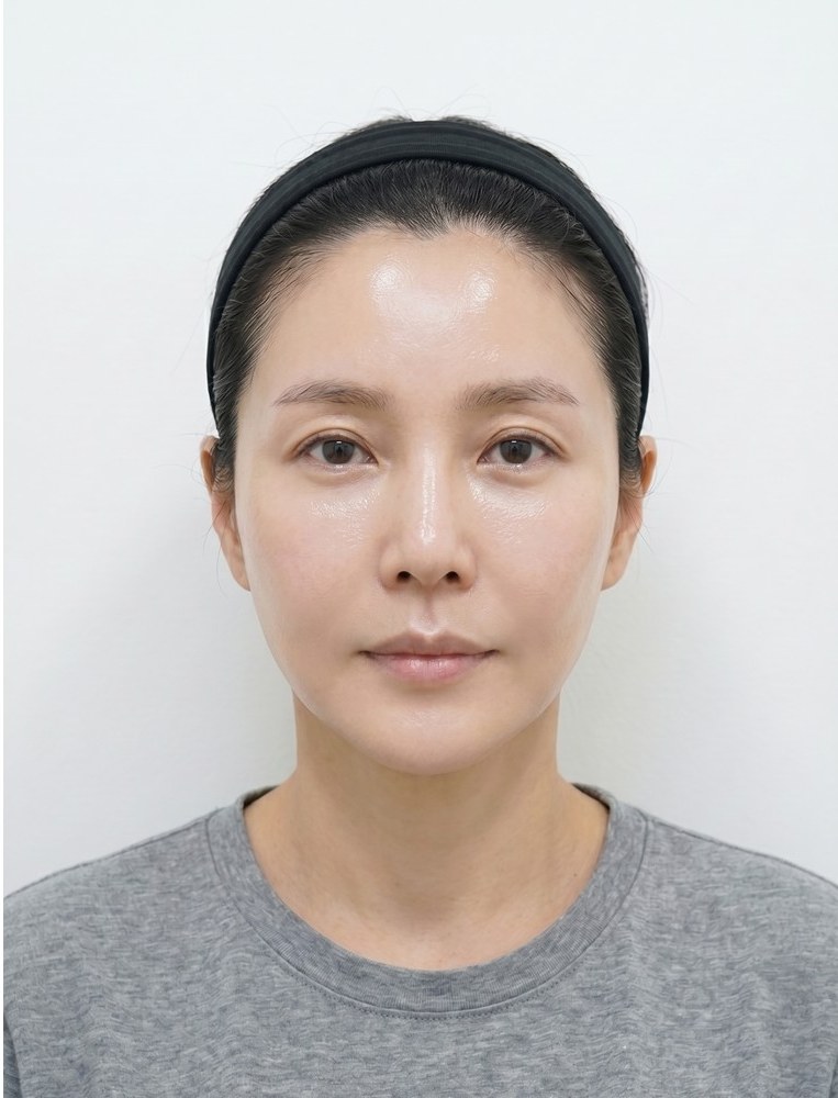 울쎄라 after